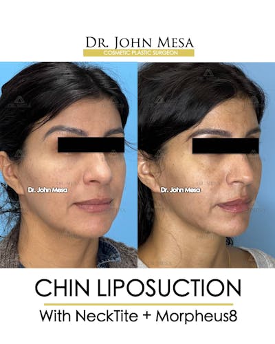 Chin Liposuction Before & After Gallery - Patient 157104124 - Image 2