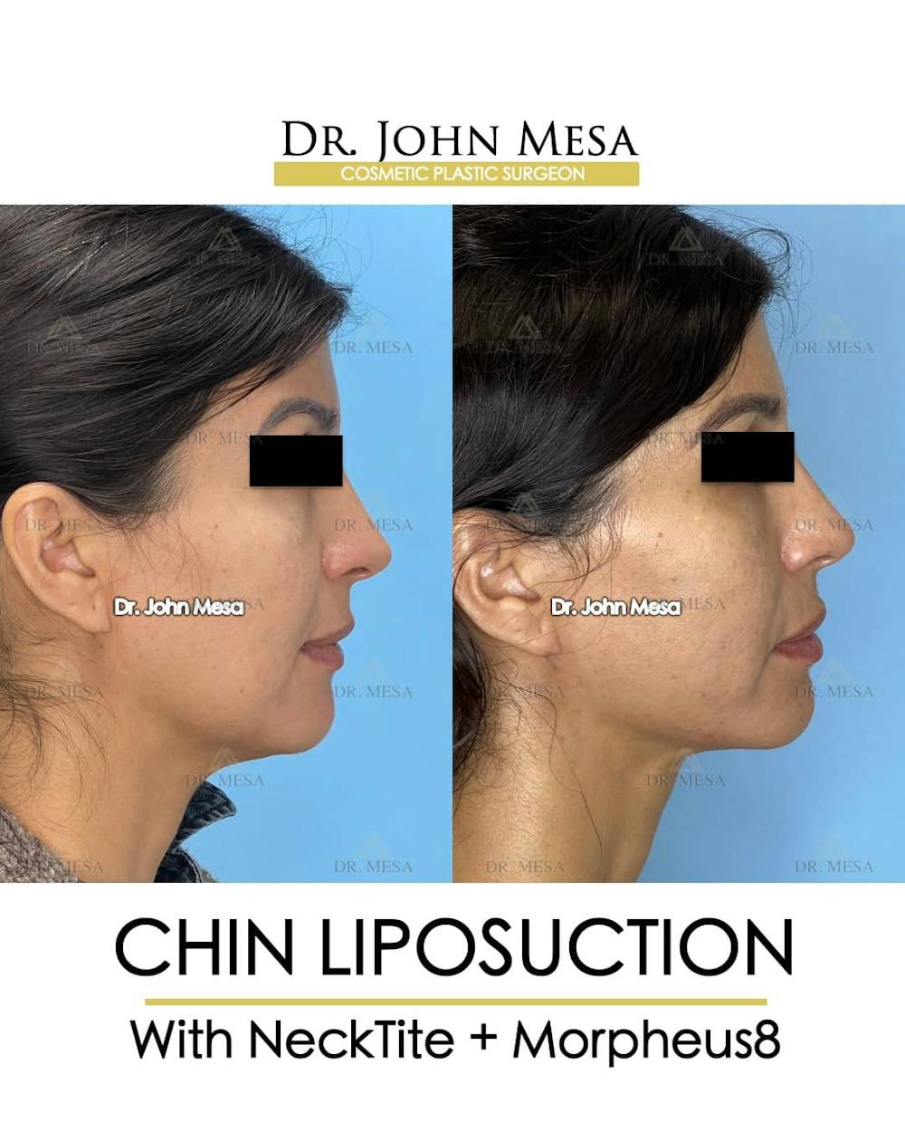 Patient 157104124, Chin Liposuction Before & After Photos