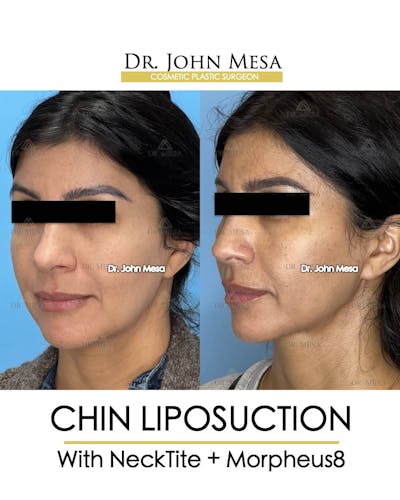 Chin Liposuction Before & After Gallery - Patient 157104124 - Image 4