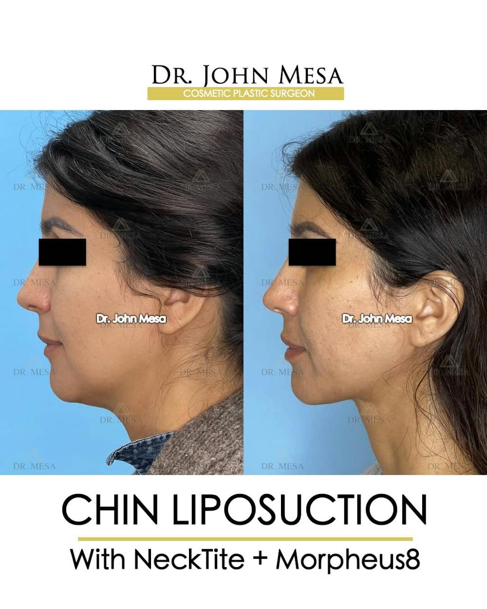 Chin Liposuction Before & After Gallery - Patient 157104124 - Image 5