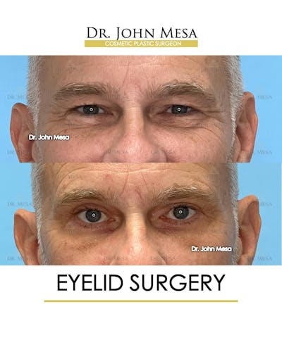 Eyelid Surgery Before & After Gallery - Patient 157104138 - Image 1
