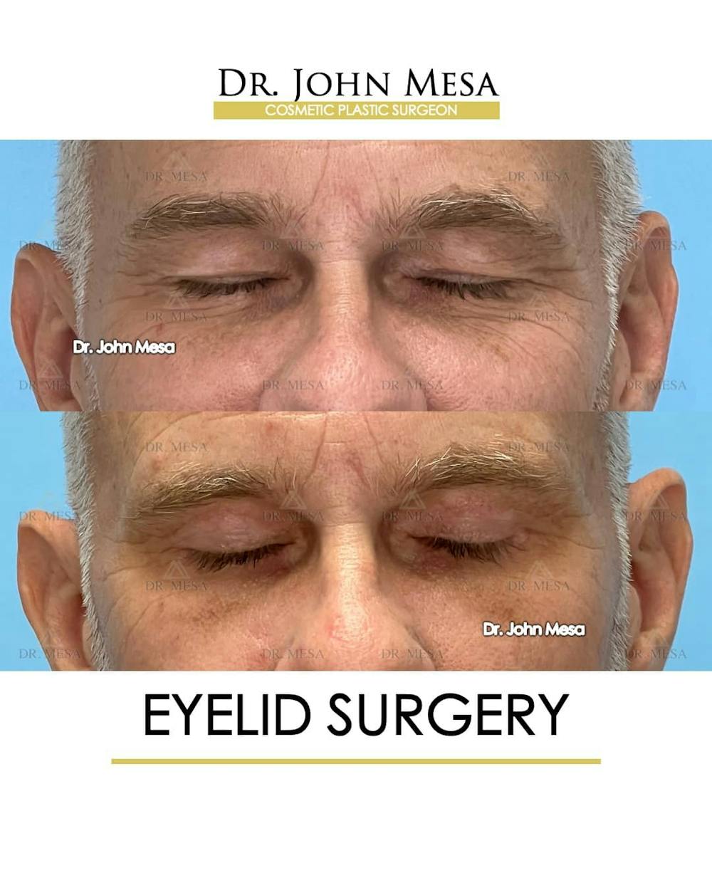 Eyelid Surgery Before & After Gallery - Patient 157104138 - Image 2