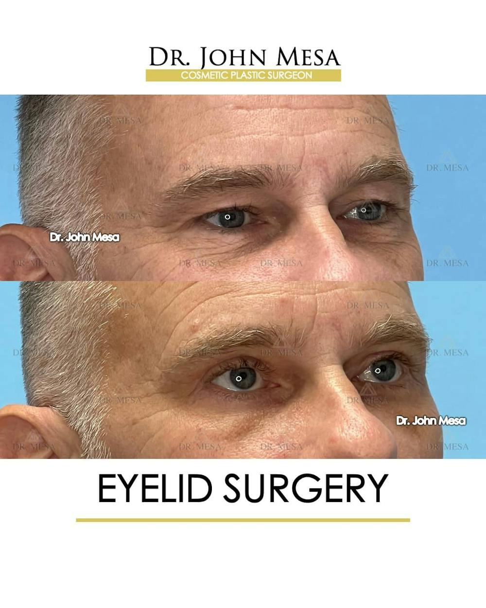 Eyelid Surgery Before & After Gallery - Patient 157104138 - Image 3