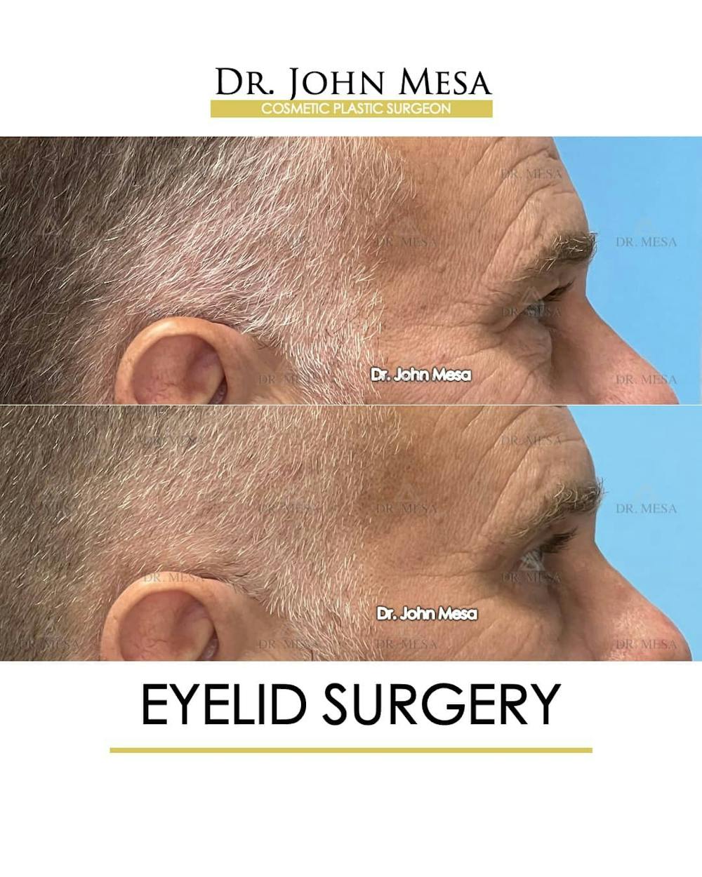 Eyelid Surgery Before & After Gallery - Patient 157104138 - Image 4