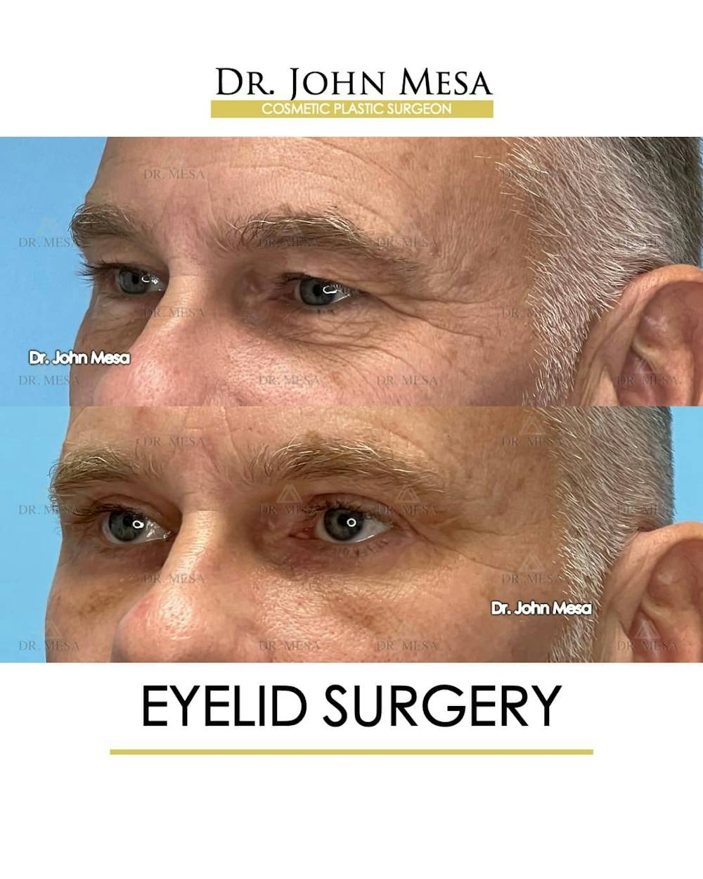 Eyelid Surgery Before & After Gallery - Patient 157104138 - Image 5