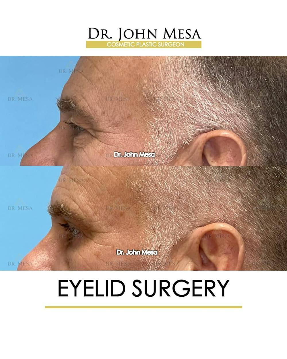 Eyelid Surgery Before & After Gallery - Patient 157104138 - Image 6