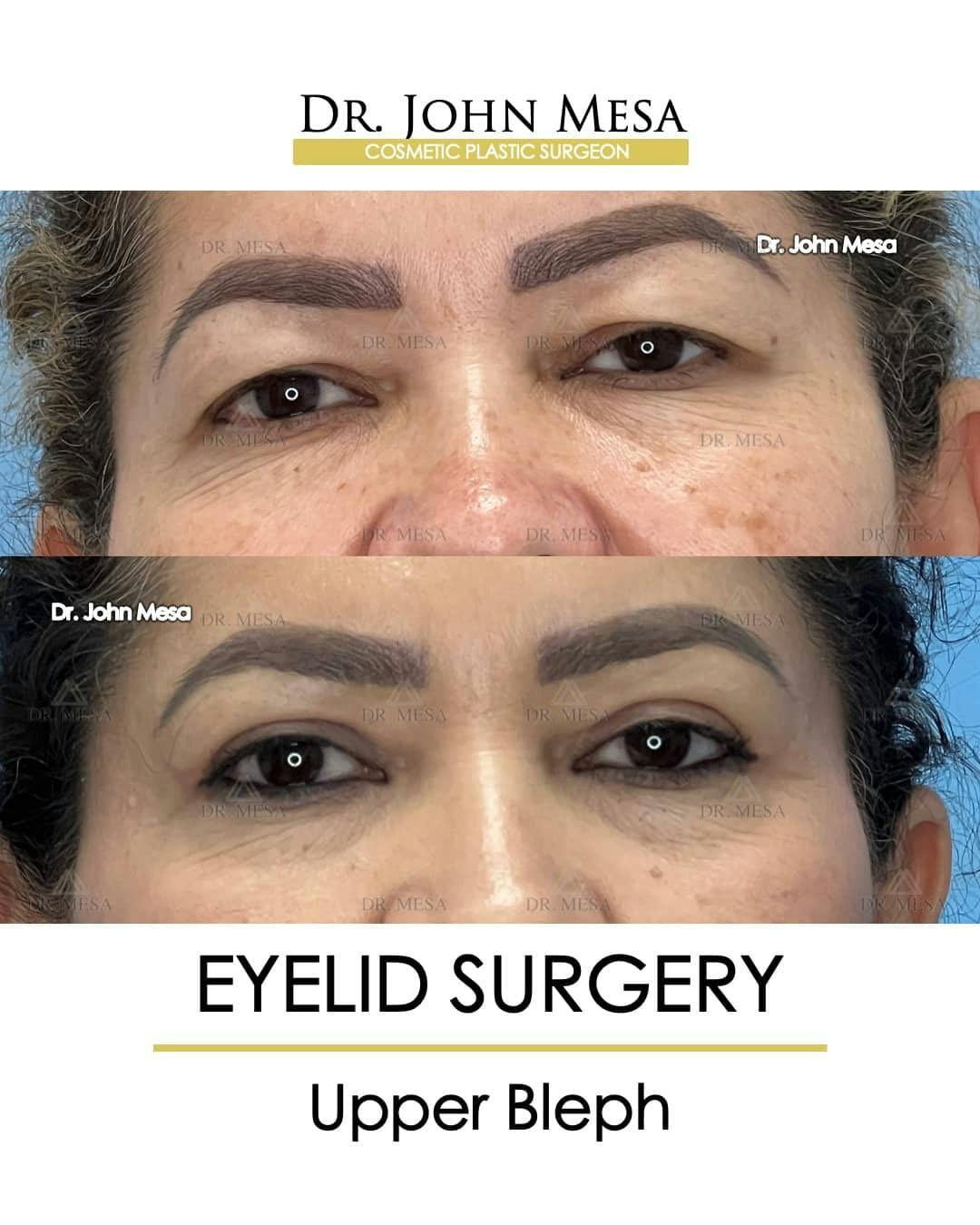 Eyelid Lift Surgery Before & After Gallery - Patient 157104140 - Image 1