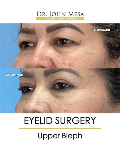 Eyelid Lift Surgery Before & After Gallery - Patient 157104140 - Image 2