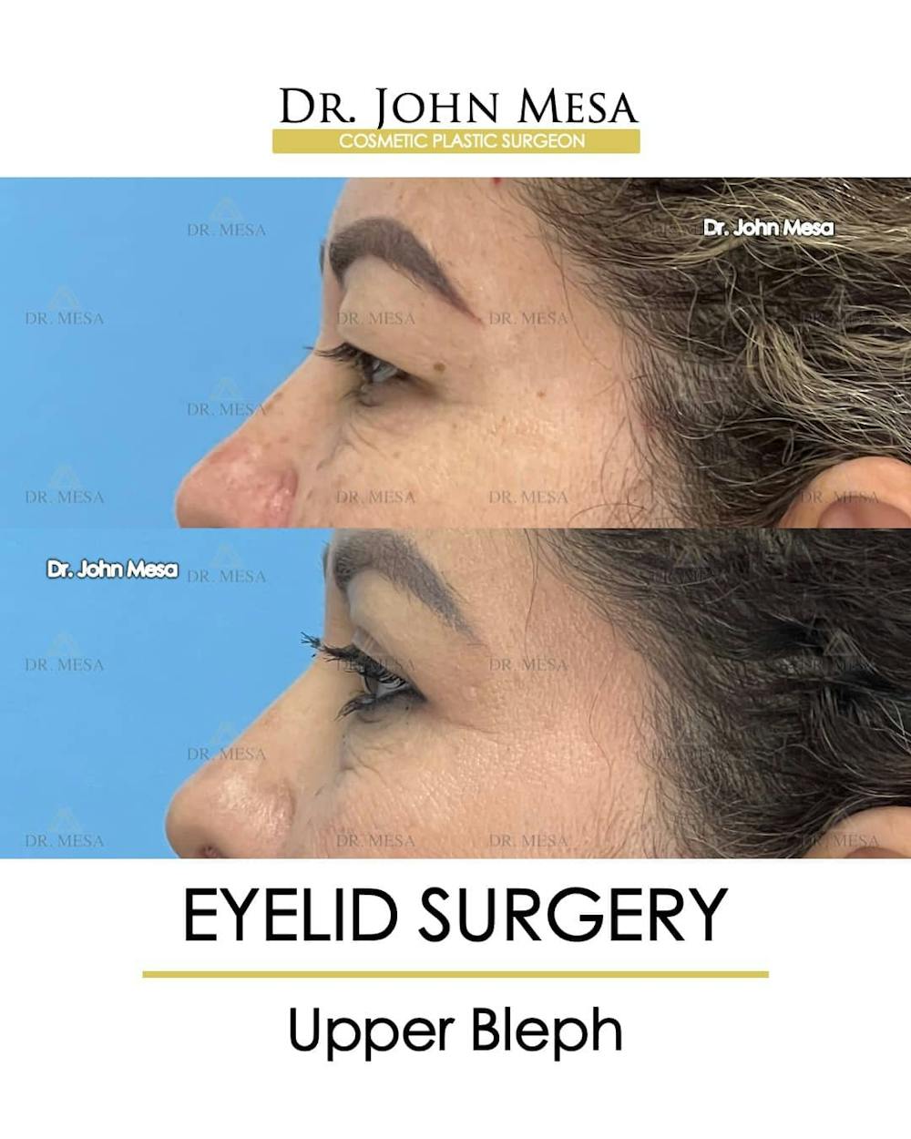 Eyelid Lift Surgery Before & After Gallery - Patient 157104140 - Image 3