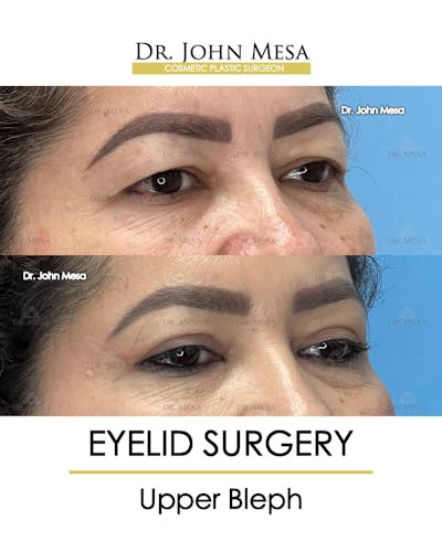 Eyelid Lift Surgery Before & After Gallery - Patient 157104140 - Image 4