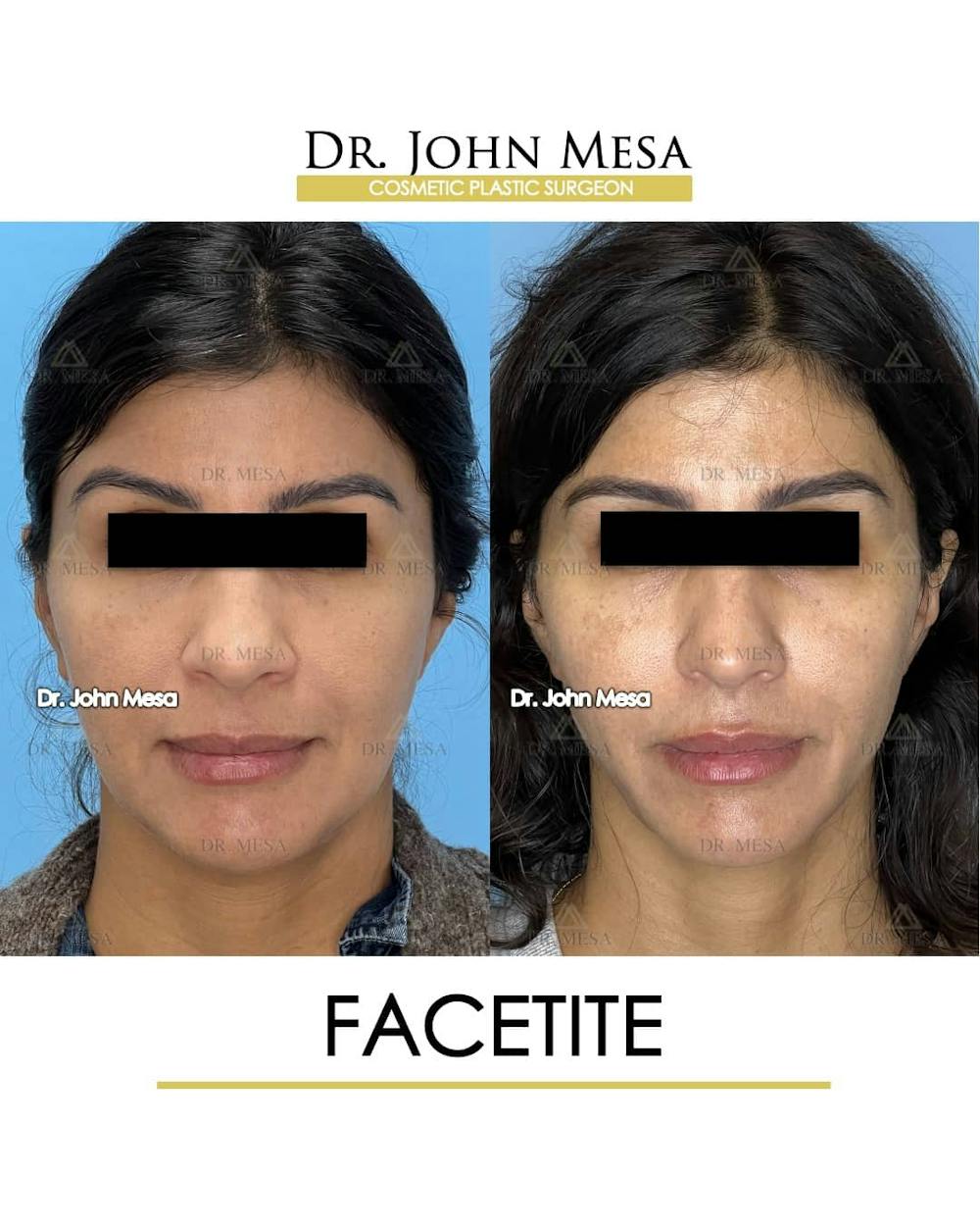 FaceTite Before & After Gallery - Patient 157104144 - Image 1