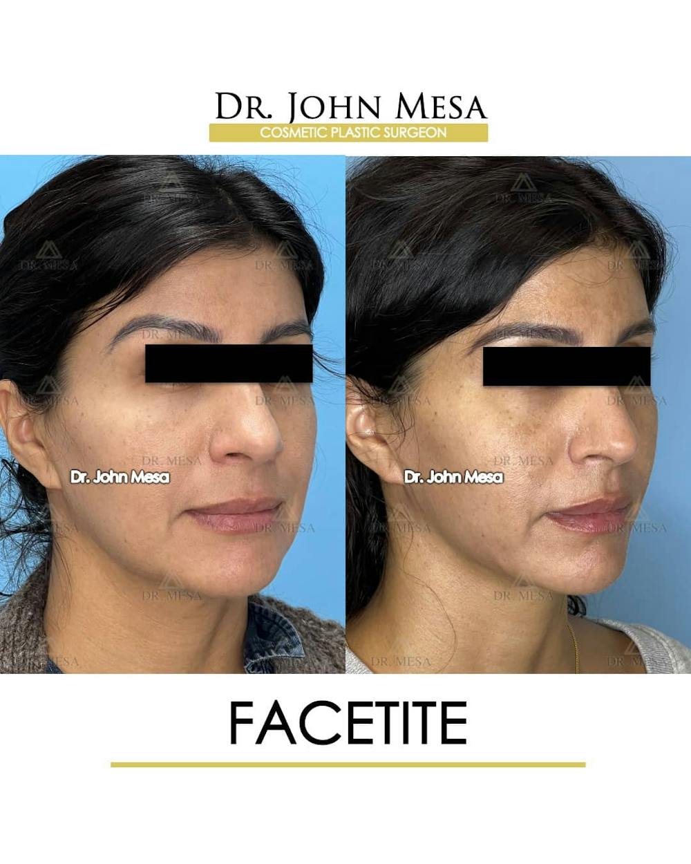 FaceTite Before & After Gallery - Patient 157104144 - Image 2