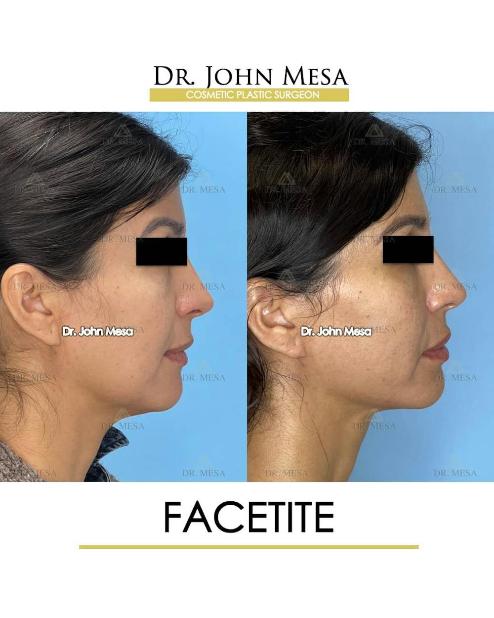 FaceTite Before & After Gallery - Patient 157104144 - Image 3