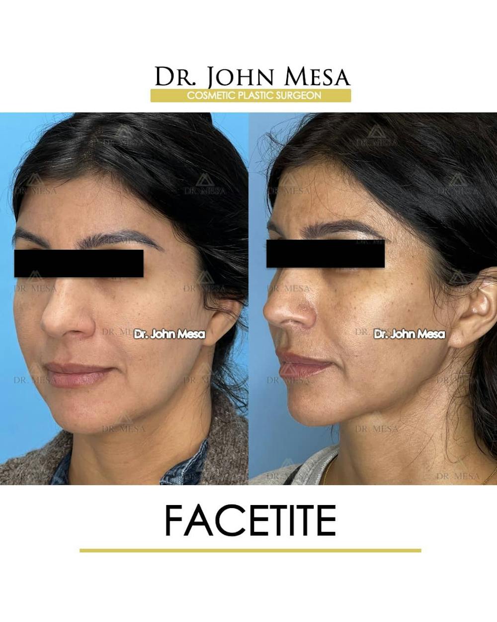 FaceTite Before & After Gallery - Patient 157104144 - Image 4