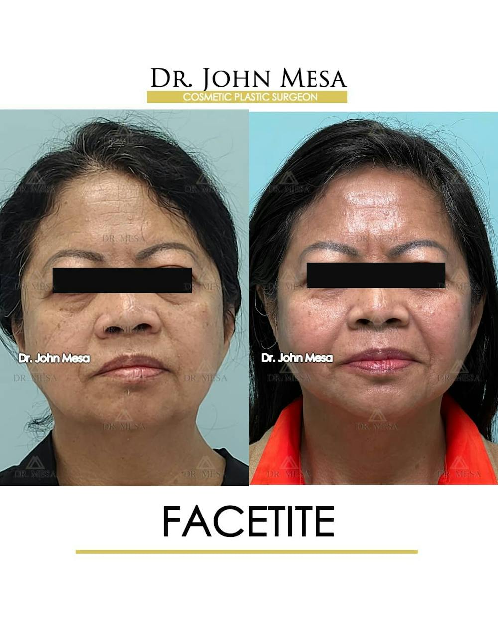 FaceTite Before & After Gallery - Patient 157104145 - Image 1