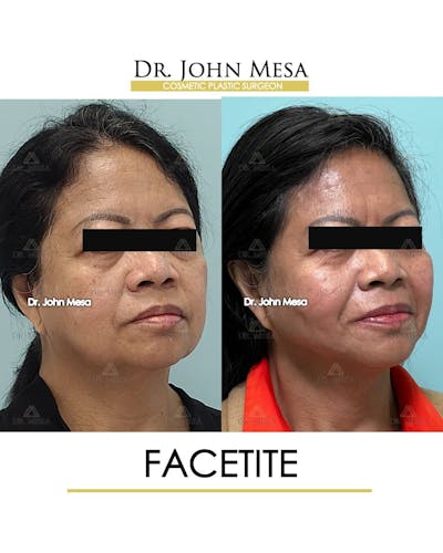 FaceTite Before & After Gallery - Patient 157104145 - Image 2
