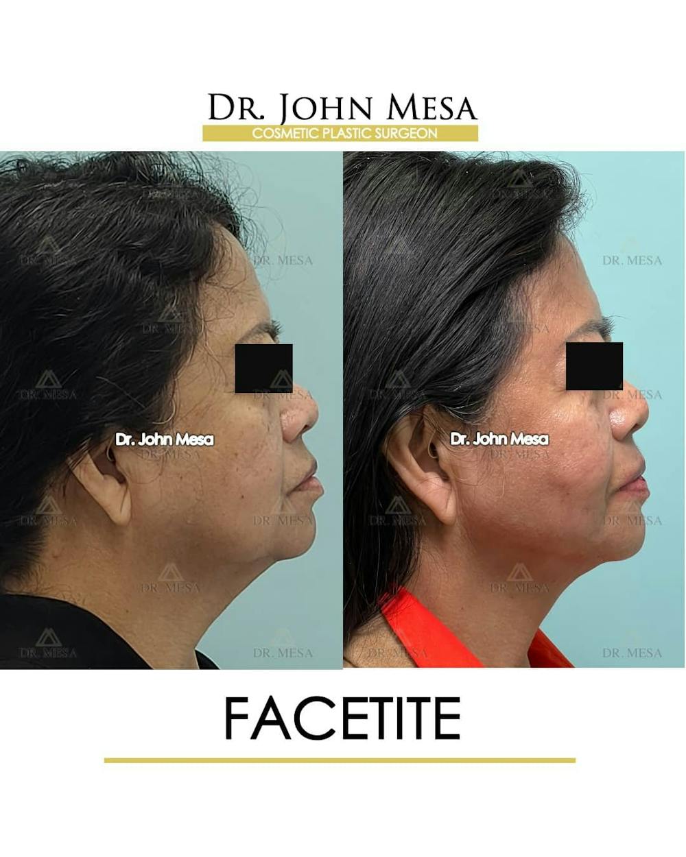 FaceTite Before & After Gallery - Patient 157104145 - Image 3