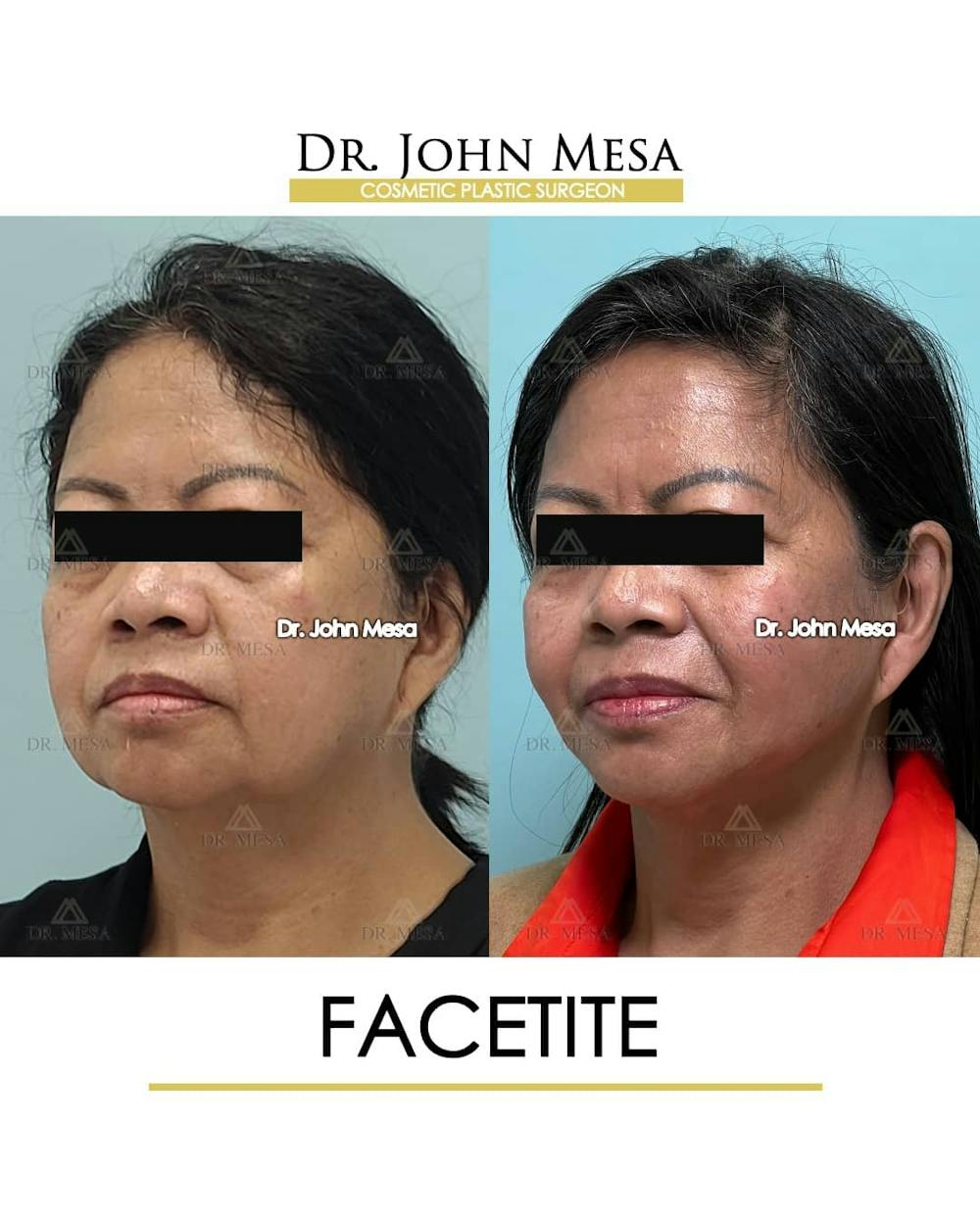 FaceTite Before & After Gallery - Patient 157104145 - Image 4
