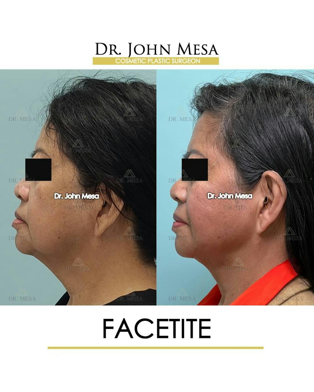 FaceTite Before & After Gallery - Patient 157104145 - Image 5