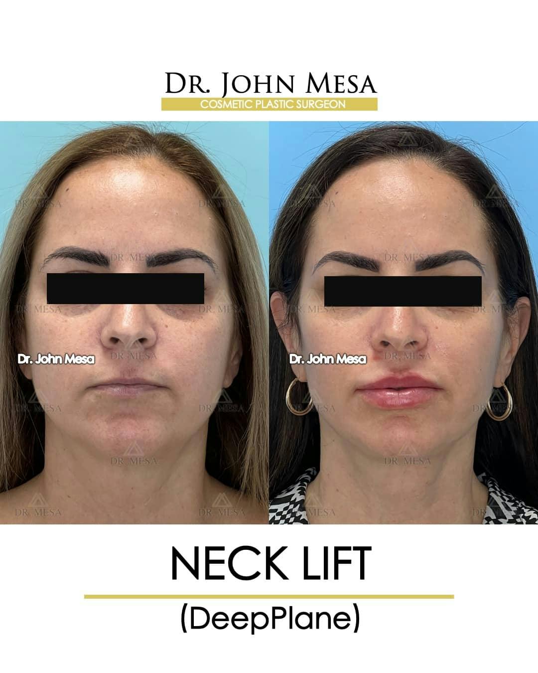 Neck Lift Before & After Gallery - Patient 157356933 - Image 1
