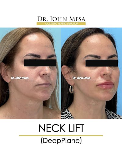 Neck Lift Before & After Gallery - Patient 157356933 - Image 2