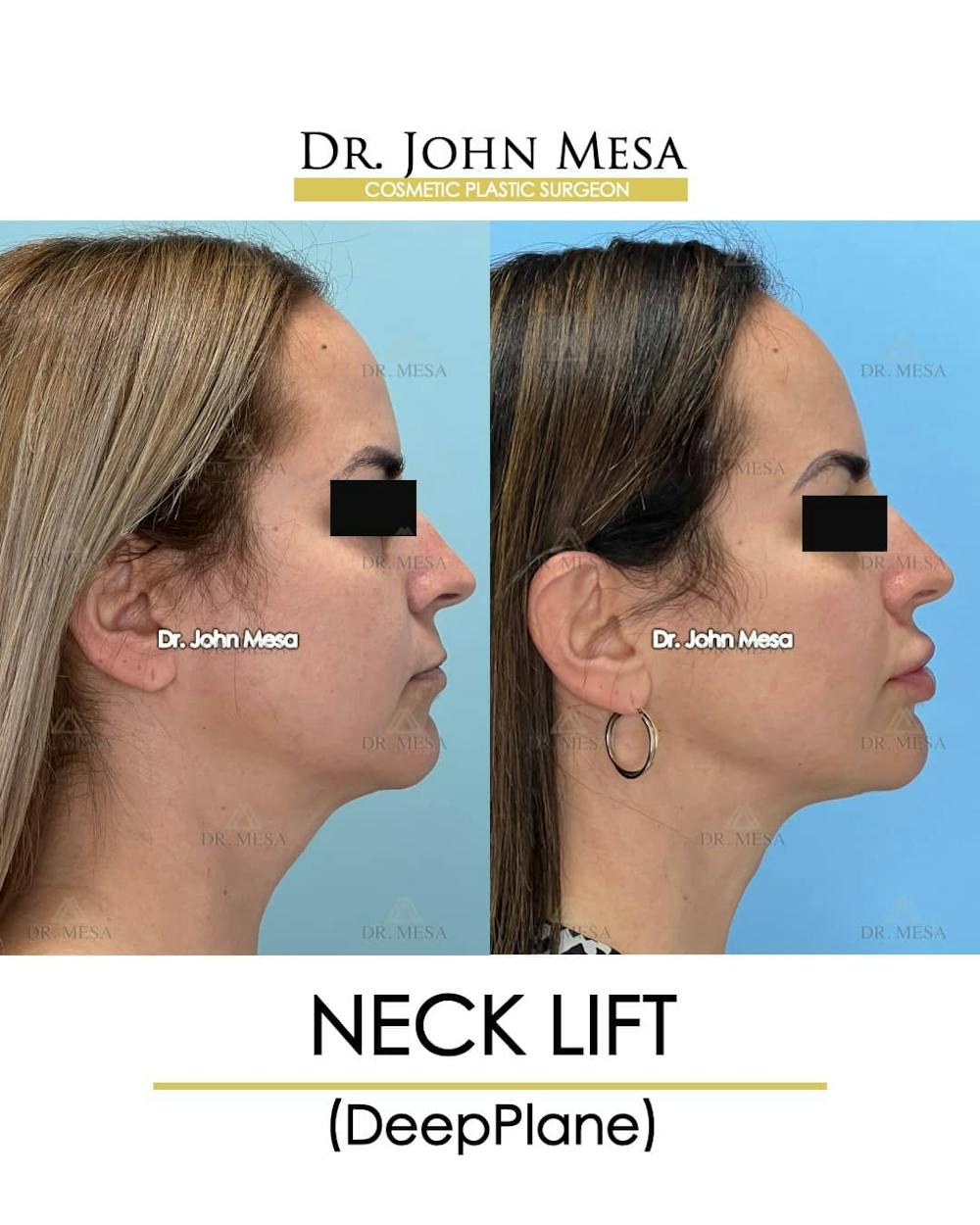 Neck Lift Before & After Gallery - Patient 157356933 - Image 3