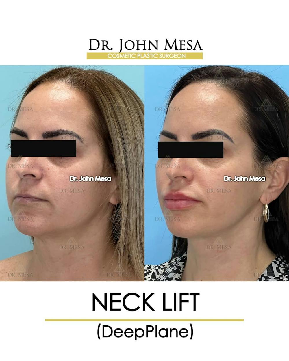 Neck Lift Before & After Gallery - Patient 157356933 - Image 4