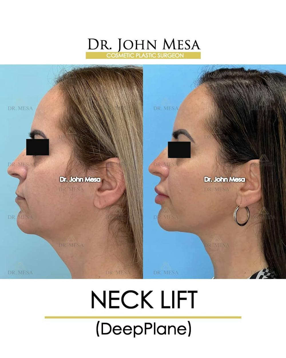 Neck Lift Before & After Gallery - Patient 157356933 - Image 5