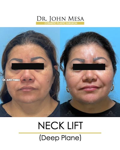 Neck Lift Before & After Gallery - Patient 157356934 - Image 1