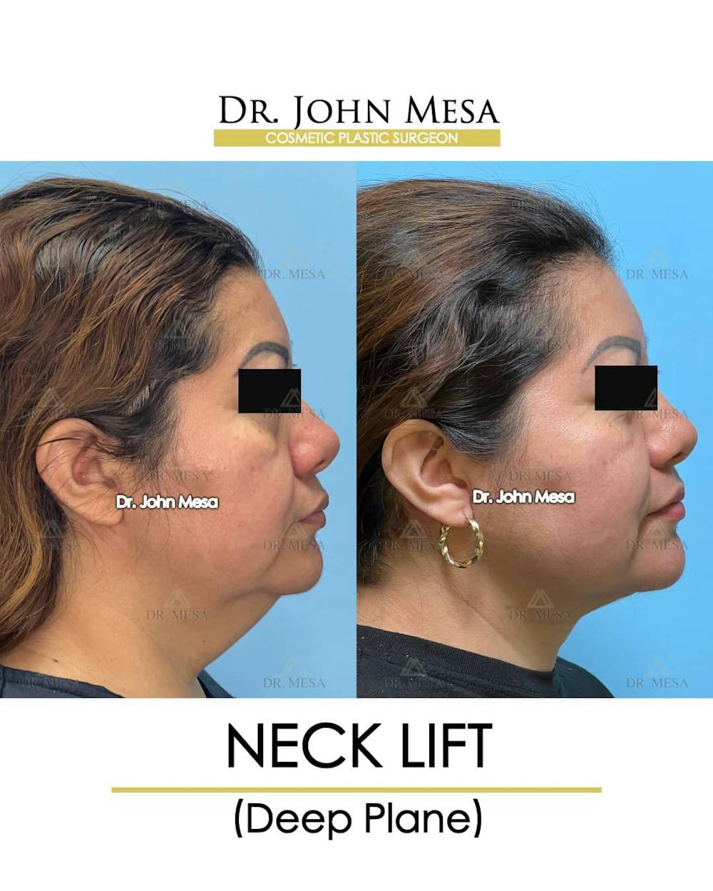 Neck Lift Before & After Gallery - Patient 157356934 - Image 2