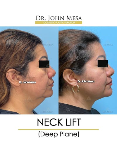 Neck Lift Before & After Gallery - Patient 157356934 - Image 2