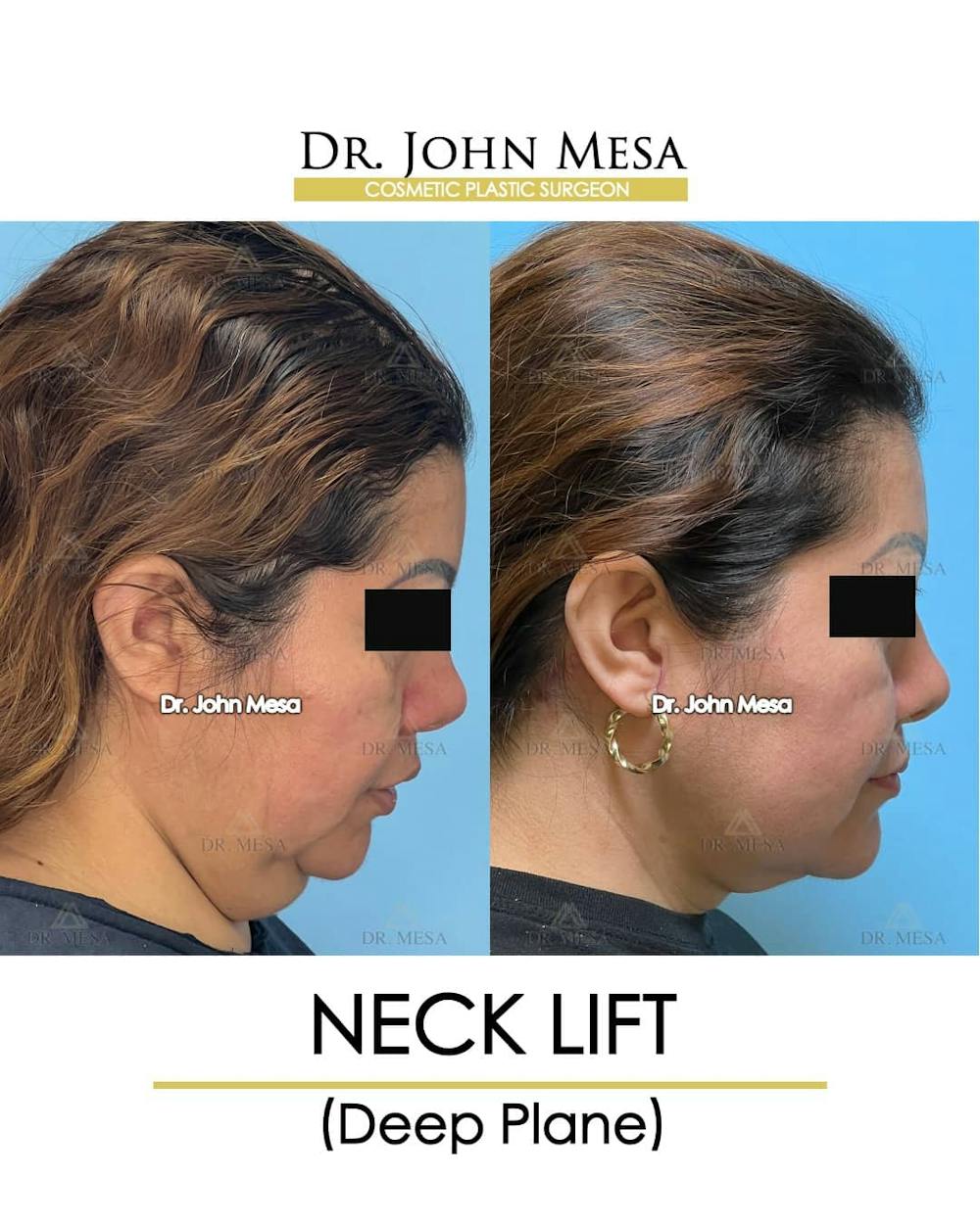 Neck Lift Before & After Gallery - Patient 157356934 - Image 3