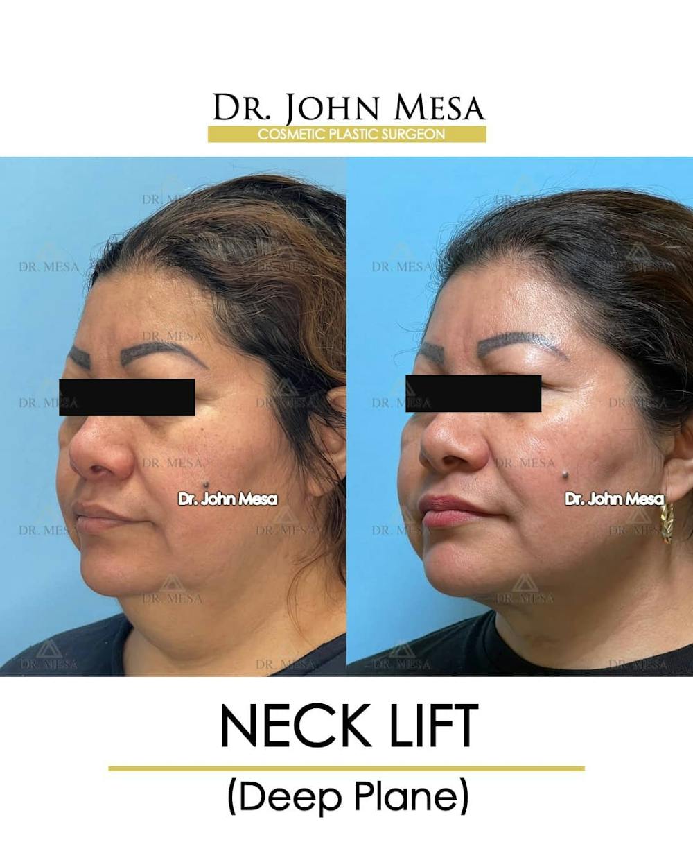 Neck Lift Before & After Gallery - Patient 157356934 - Image 4