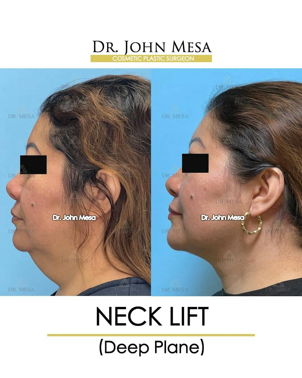 Neck Lift Before & After Gallery - Patient 157356934 - Image 5