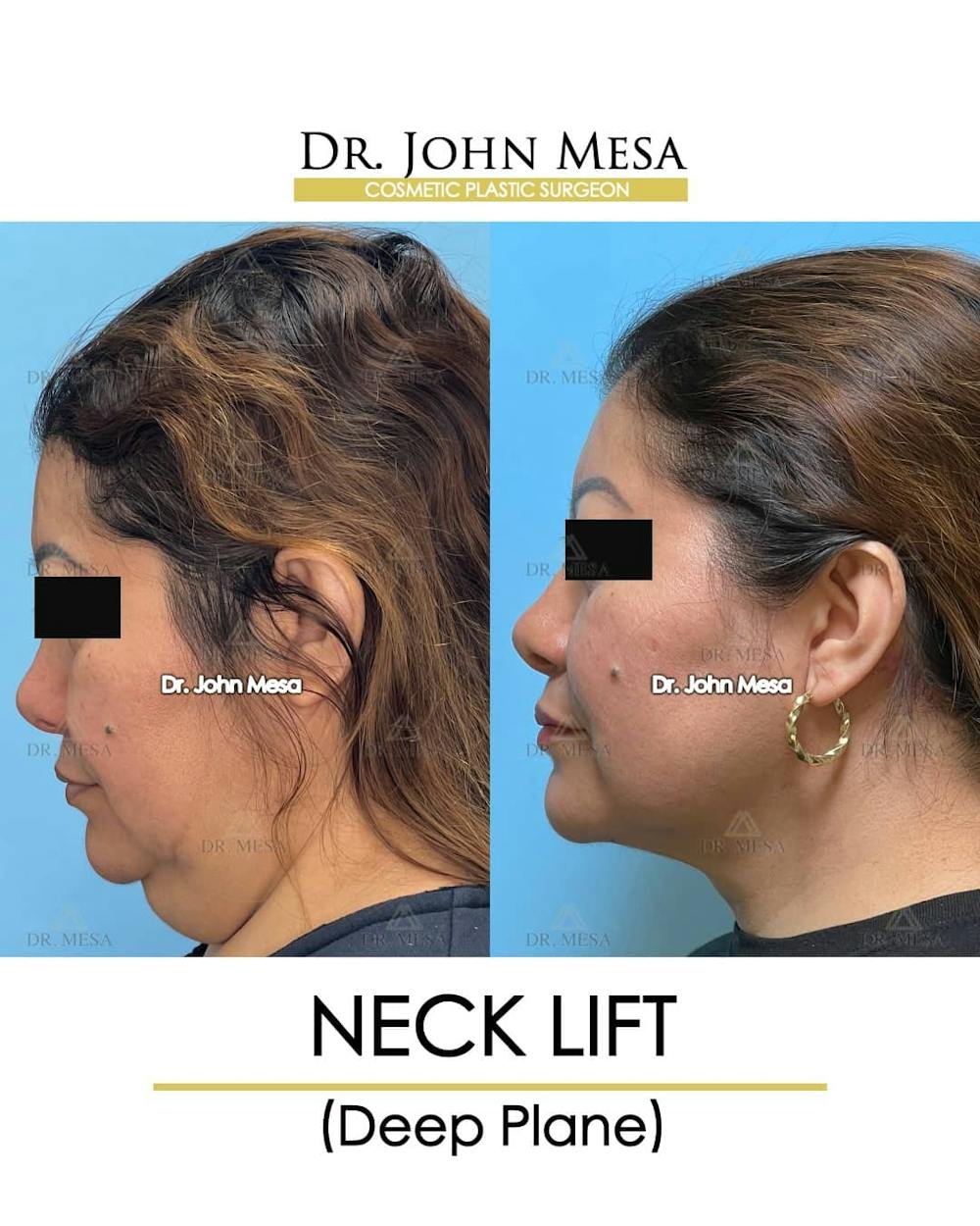Neck Lift Before & After Gallery - Patient 157356934 - Image 6