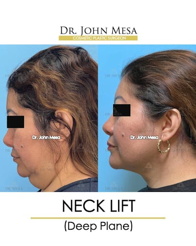 Neck Lift Before & After Gallery - Patient 157356934 - Image 6