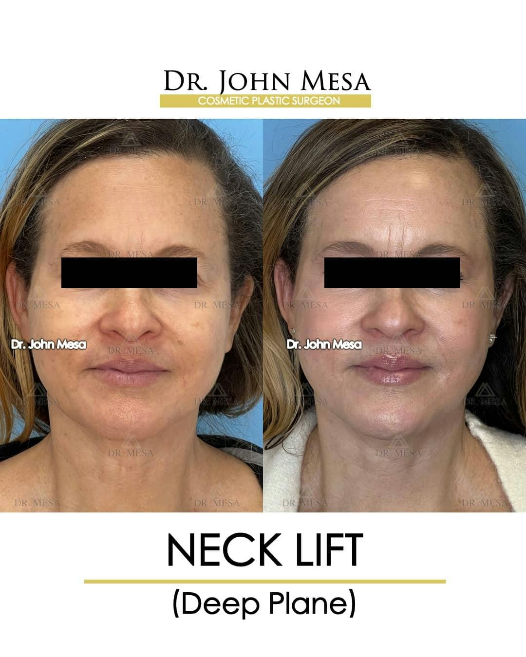 Neck Lift Before & After Gallery - Patient 157356935 - Image 1