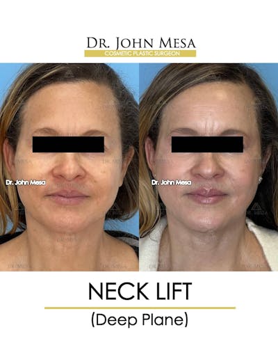 Neck Lift Before & After Gallery - Patient 157356935 - Image 1
