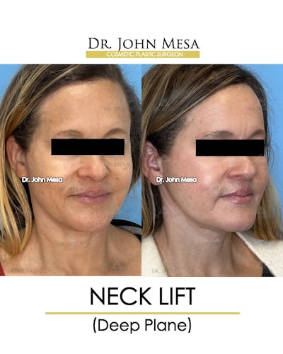 Neck Lift Before & After Gallery - Patient 157356935 - Image 2