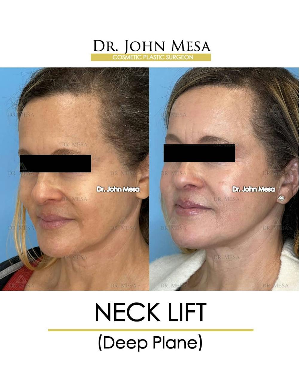 Neck Lift Before & After Gallery - Patient 157356935 - Image 3