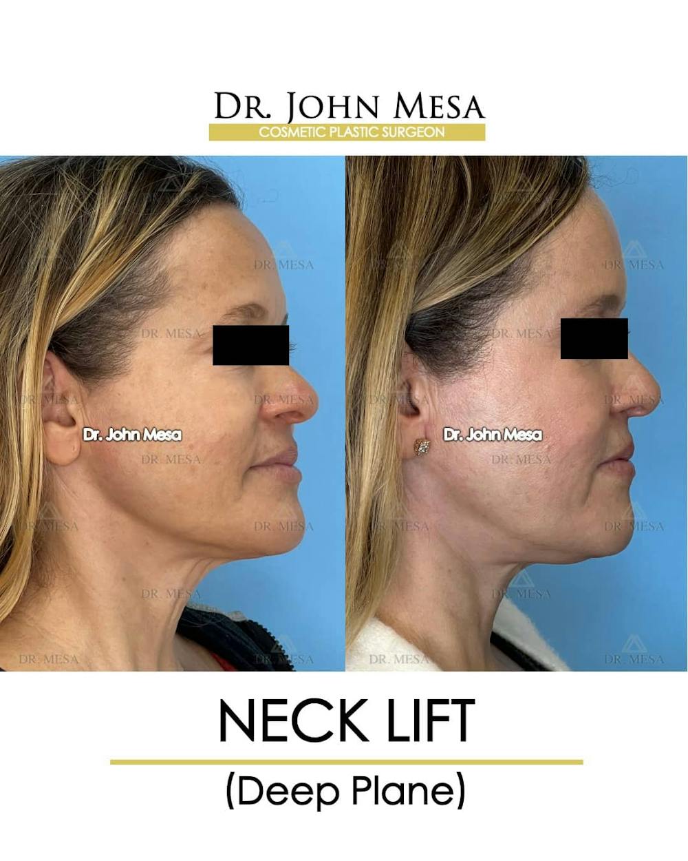 Neck Lift Before & After Gallery - Patient 157356935 - Image 4