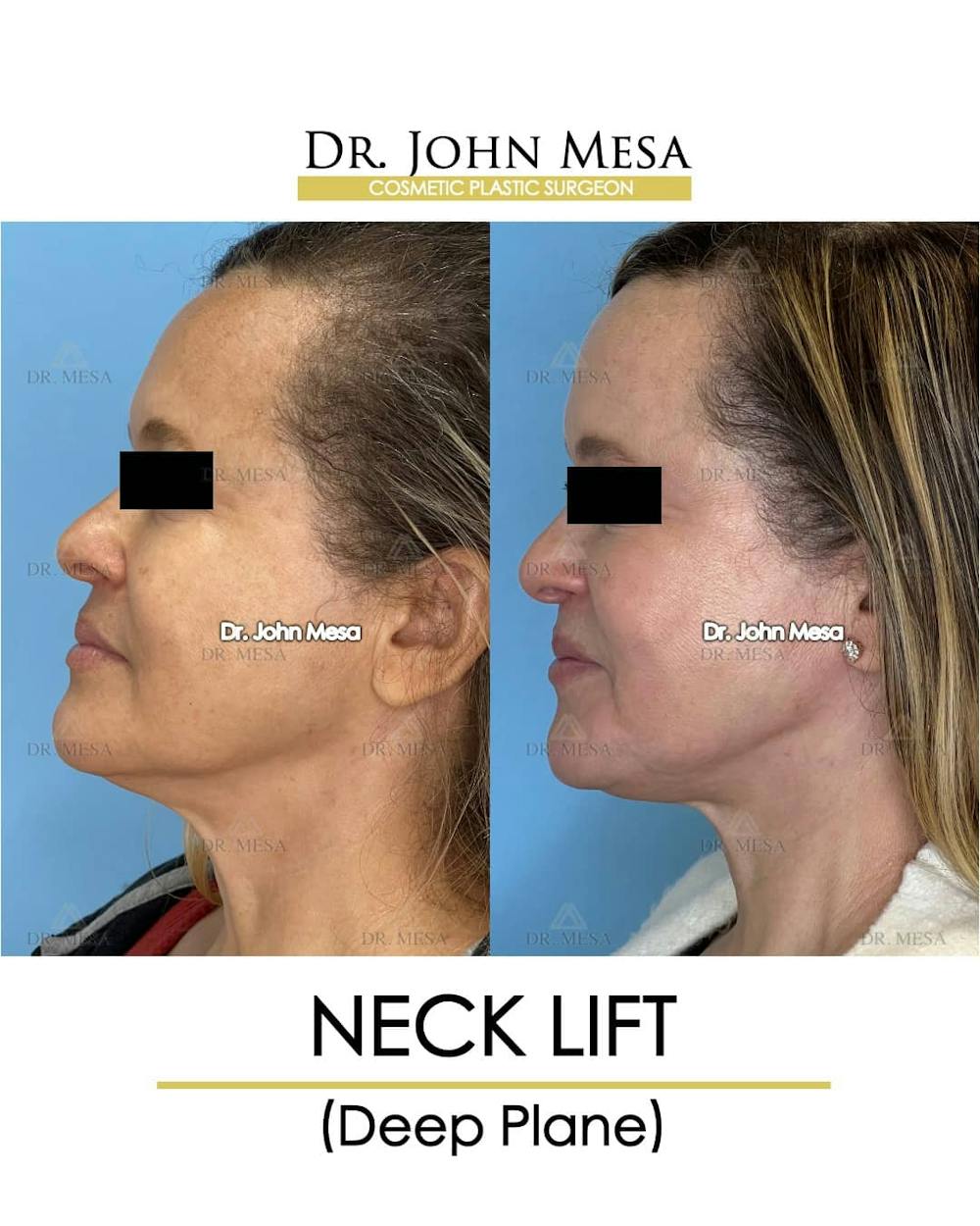 Neck Lift Before & After Gallery - Patient 157356935 - Image 5