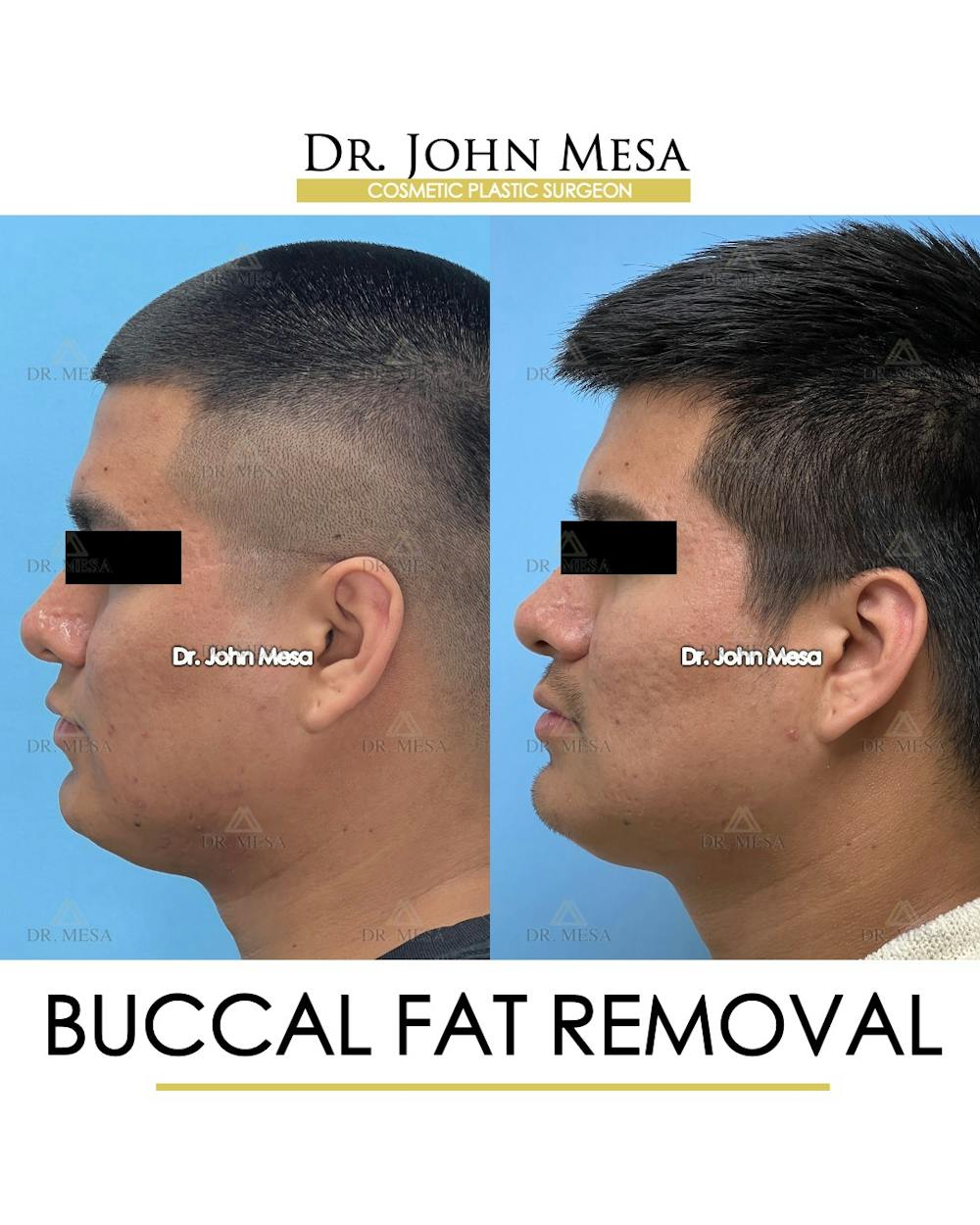 Buccal Fat Pad Removal for Men Before & After Gallery - Patient 174900584 - Image 5