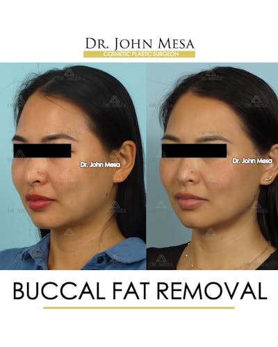 Buccal Fat Pad Removal Before & After Gallery - Patient 174900493 - Image 4
