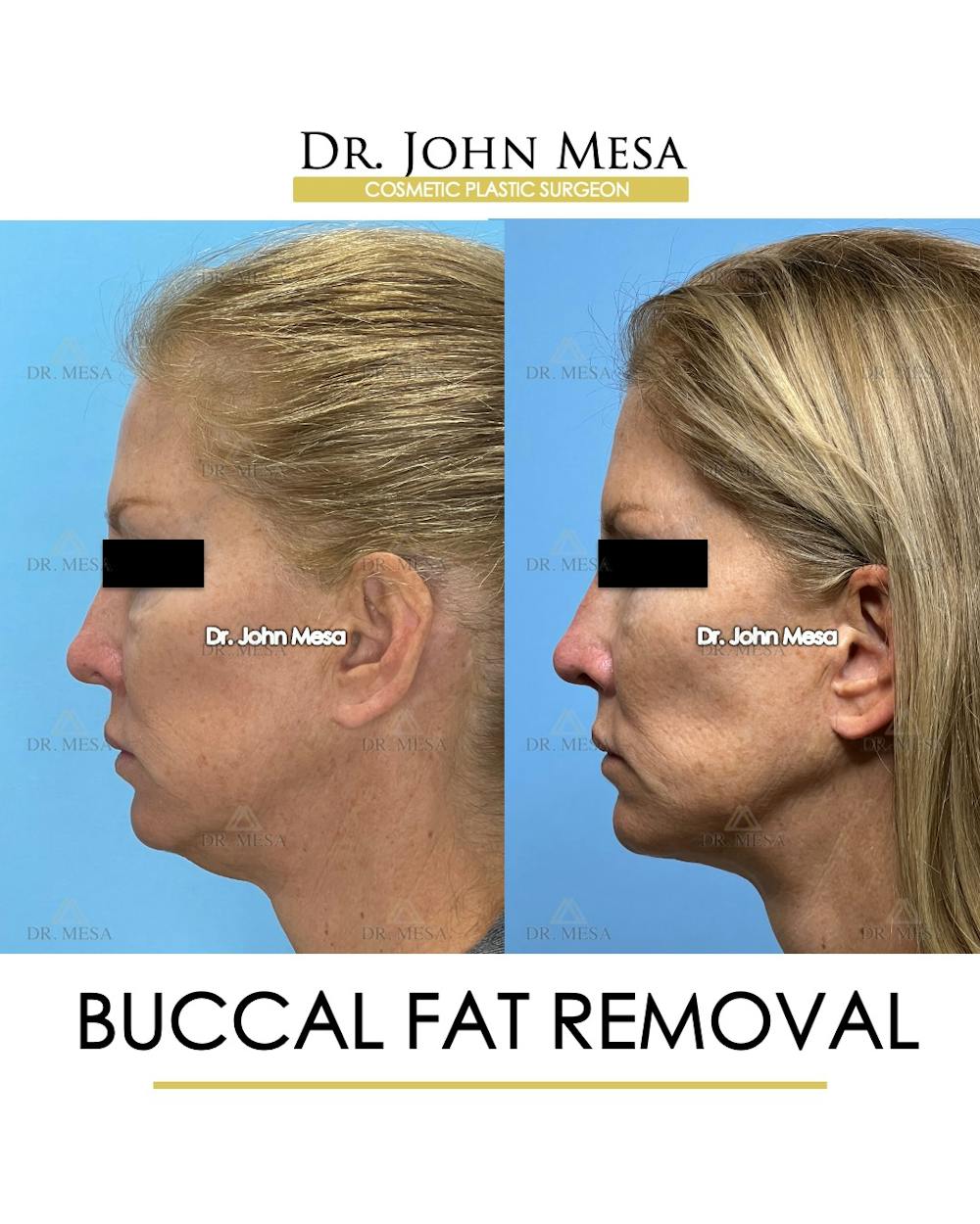 Buccal Fat Pad Removal Before & After Gallery - Patient 174900506 - Image 5