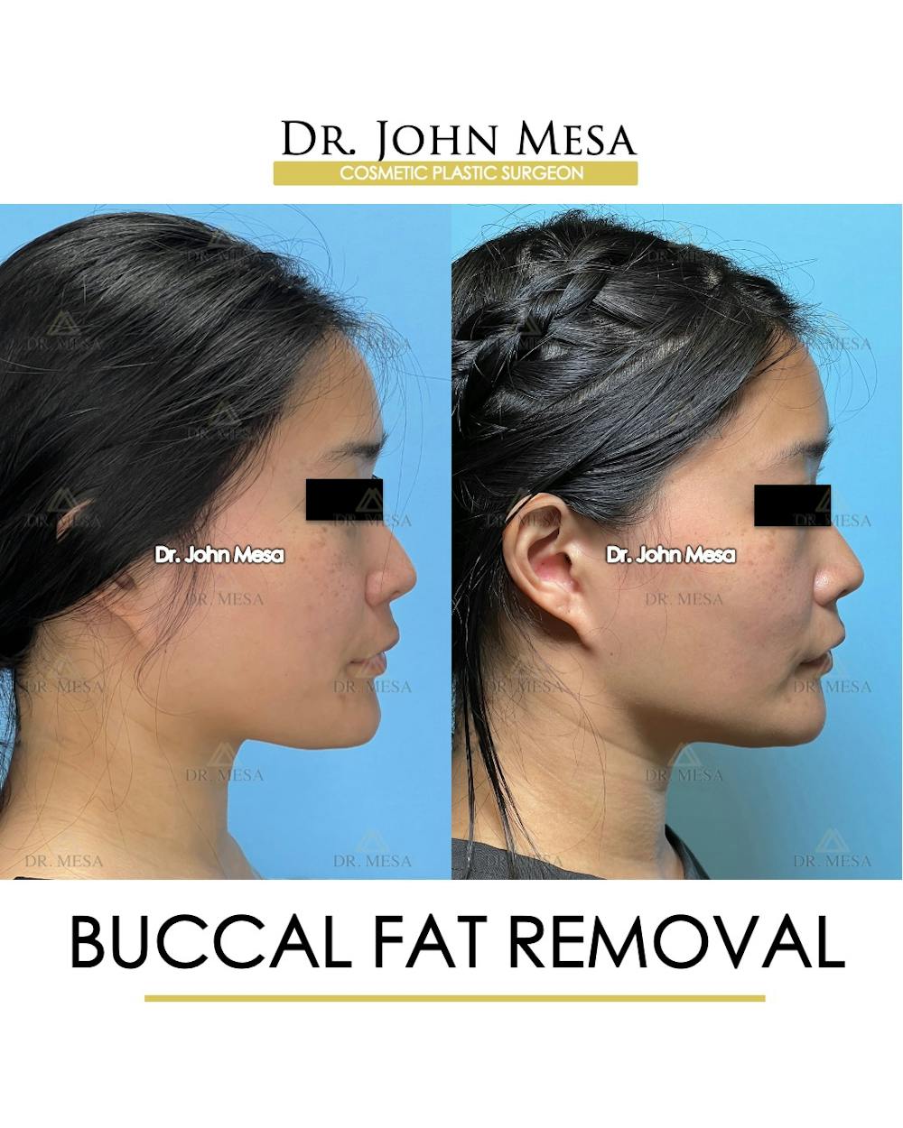 Buccal Fat Pad Removal Before & After Gallery - Patient 174900496 - Image 3