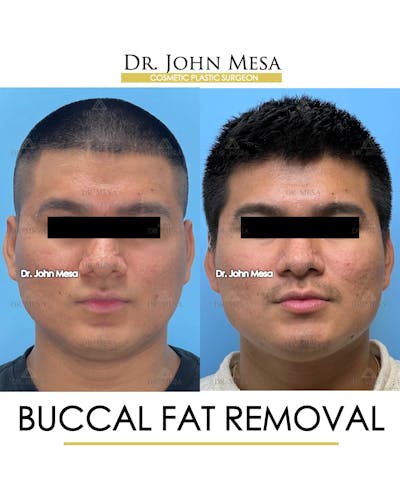 Buccal Fat Pad Removal for Men Before & After Gallery - Patient 174900584 - Image 1