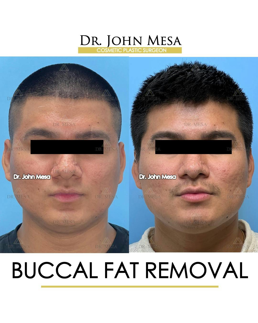 Buccal Fat Pad Removal for Men Before & After Gallery - Patient 174900584 - Image 1