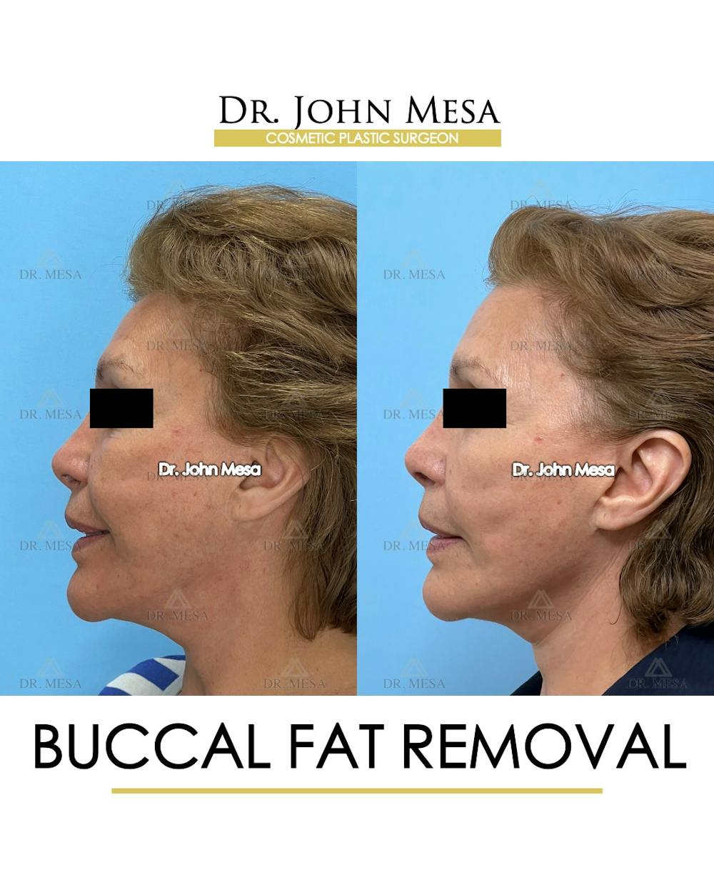 Buccal Fat Pad Removal Before & After Gallery - Patient 174900505 - Image 5