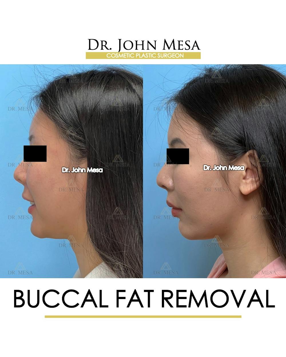 Buccal Fat Pad Removal Before & After Gallery - Patient 174900494 - Image 5